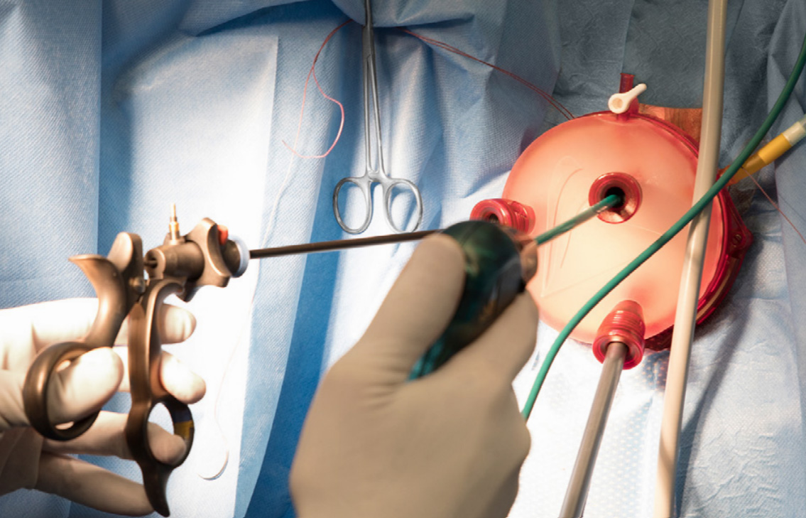 Chirurgie annexielle V-NOTES 