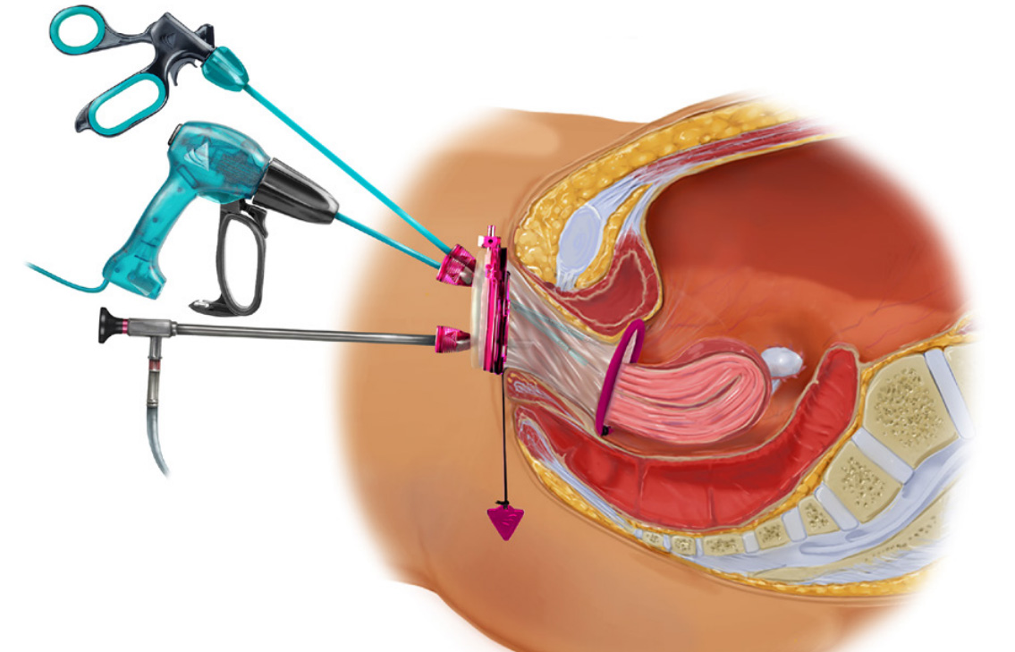 Hystérectomie coelio-vaginale assistée V-NOTES