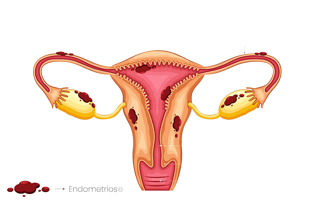 Endometriose