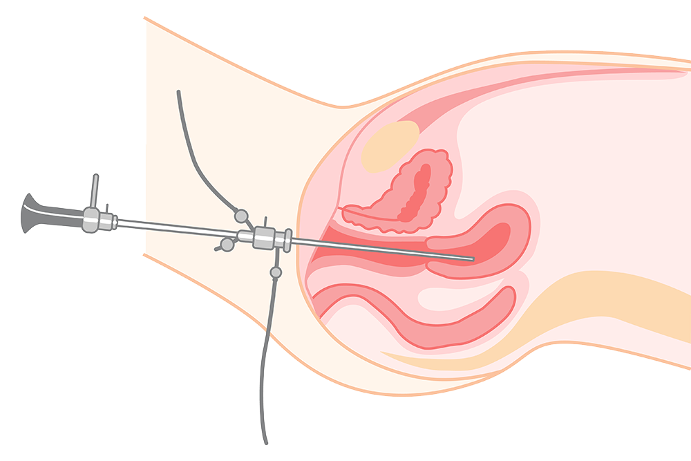 Hystérectomie