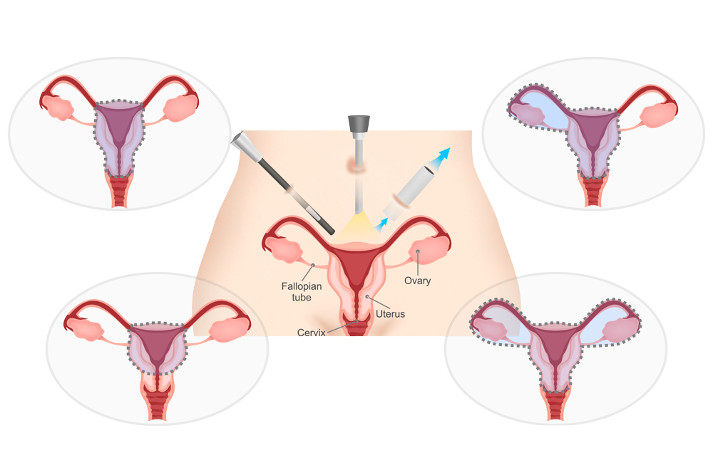 Hystérectomie par laparoscopie