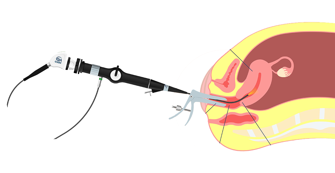hystéroscopie