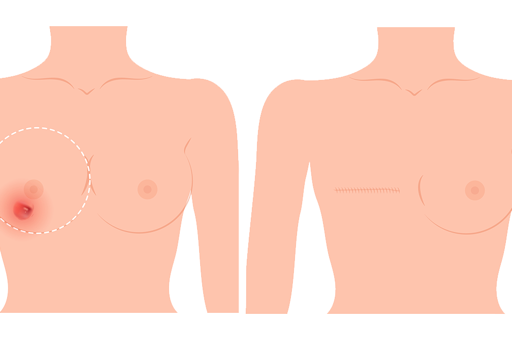 Mastectomie