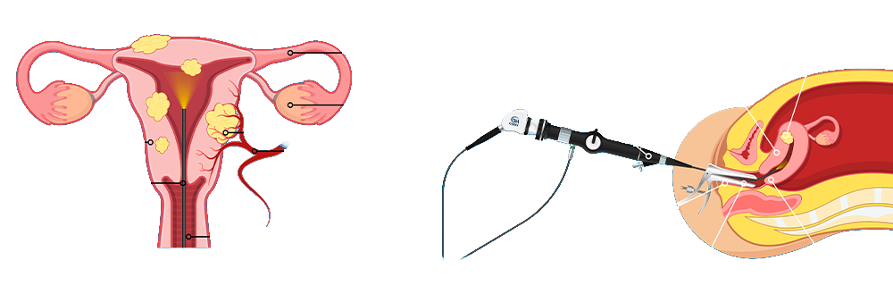 Myomectomie