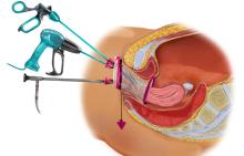Hystérectomie coelio-vaginale assistée V-NOTES